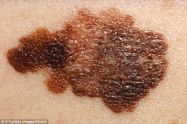 melanoma cancro della pelle